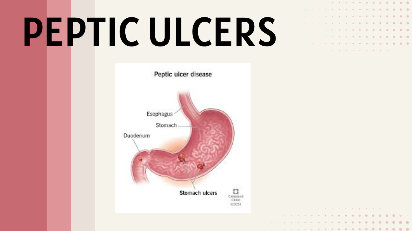 Peptic ulcer disease – Pathological Features & Slides (PPT)